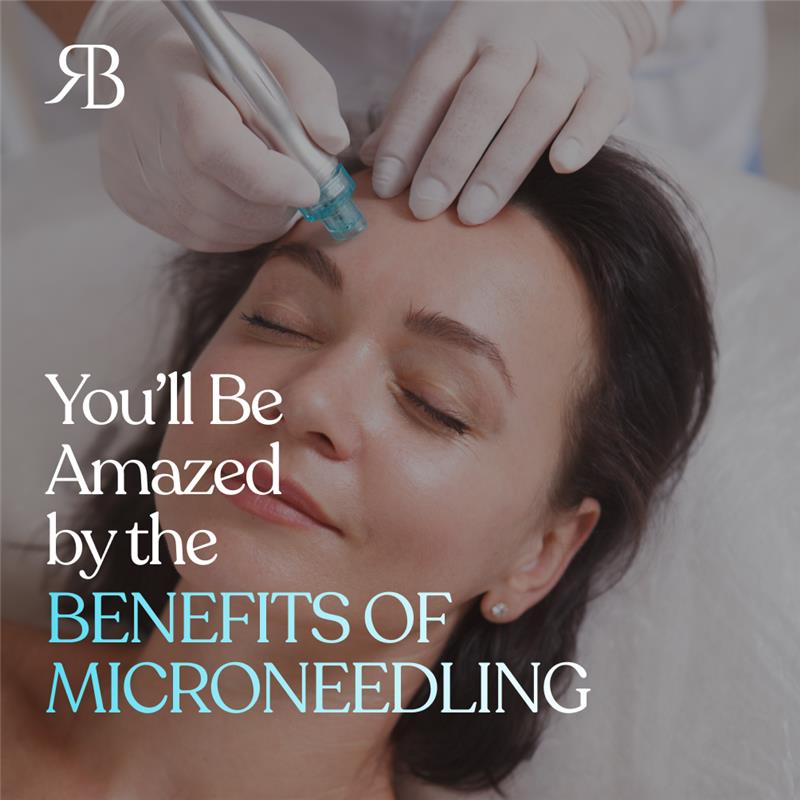 5 Skin Problems Microneedling Can Fix